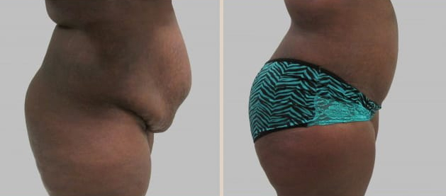 Before and After Image: Before and After Photos: Abdominoplasty (Tummy Tuck) - right-side