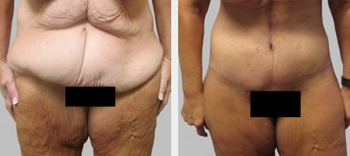 Before and After Image: Before and After Photos: Abdominoplasty (Tummy Tuck) - front
