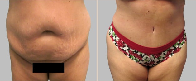 Before and After Image: Before and After Photos: Abdominoplasty (Tummy Tuck) - front