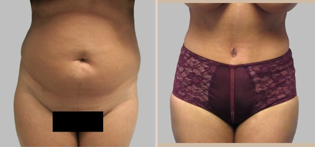 Before and After Image: Before and After Photos: Abdominoplasty (Tummy Tuck) - front