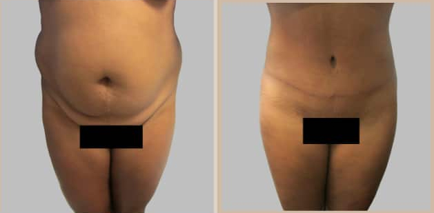 Before and After Image: Before and After Photos: Abdominoplasty (Tummy Tuck) - front