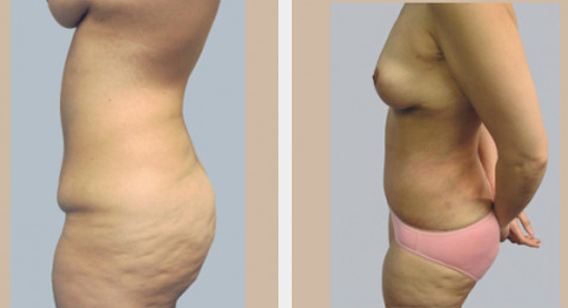 Before and After Image: Before and After Photos: Abdominoplasty (Tummy Tuck) - left-side