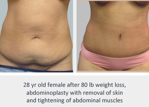 Before and After Image: Before and After Photos: Abdominoplasty (Tummy Tuck) - front