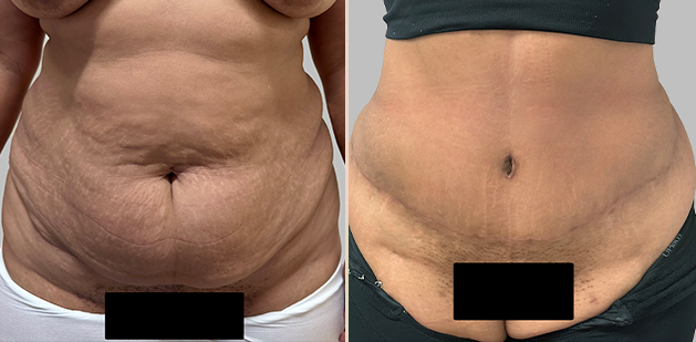 Before and After Image: Before and After Photos: Abdominoplasty (Tummy Tuck) - front