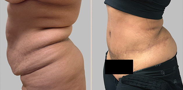 Before and After Image: Before and After Photos: Abdominoplasty (Tummy Tuck) - left-side