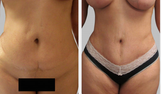Before and After Image: Before and After Photos: Abdominoplasty (Tummy Tuck) - front