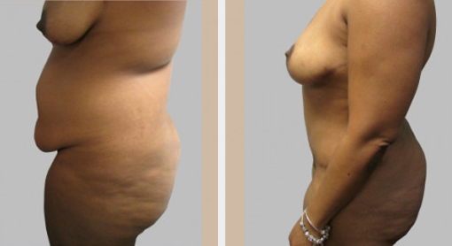 Before and After Image: Before and After Photos: Abdominoplasty (Tummy Tuck) - left-side