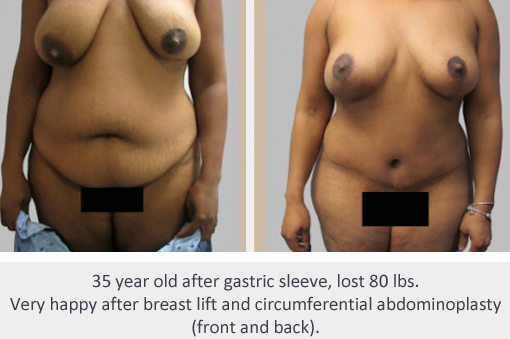 Before and After Image: Before and After Photos: Abdominoplasty (Tummy Tuck) - front