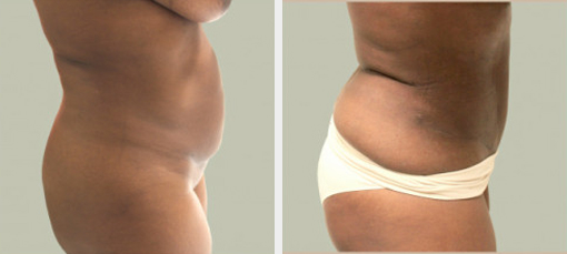 Before and After Image: Before and After Photos: Abdominoplasty (Tummy Tuck) - right-side
