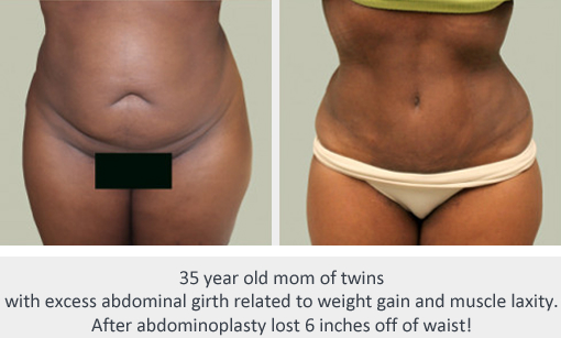 Before and After Image: Before and After Photos: Abdominoplasty (Tummy Tuck) - front