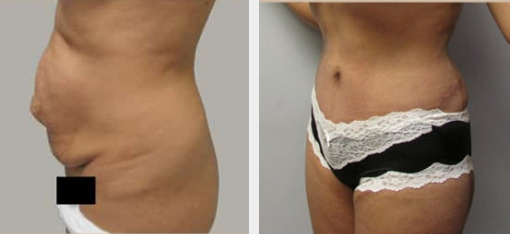 Before and After Image: Before and After Photos: Abdominoplasty (Tummy Tuck) - left-side