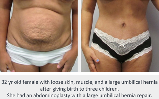 Before and After Image: Before and After Photos: Abdominoplasty (Tummy Tuck) - front