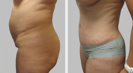 Before and After Image: Before and After Photos: Abdominoplasty (Tummy Tuck) - left-side