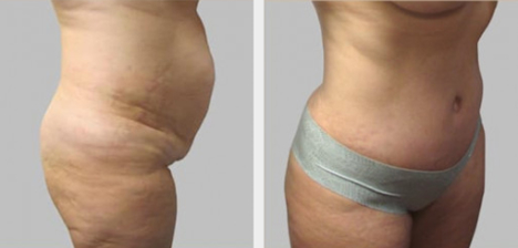 Before and After Image: Before and After Photos: Abdominoplasty (Tummy Tuck) - right-side