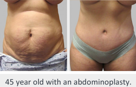 Before and After Image: Before and After Photos: Abdominoplasty (Tummy Tuck) - front