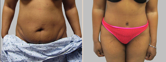 Before and After Image: Before and After Photos: Abdominoplasty (Tummy Tuck) - front