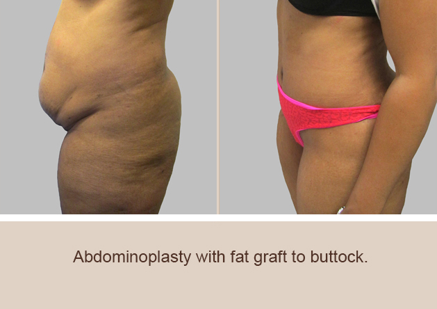 Before and After Image: Before and After Photos: Abdominoplasty (Tummy Tuck) - left-side