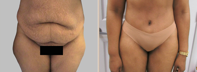 Before and After Image: Before and After Photos: Abdominoplasty (Tummy Tuck) - front