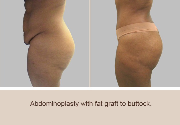 Before and After Image: Before and After Photos: Abdominoplasty (Tummy Tuck) - left-side