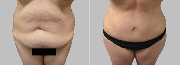 Before and After Image: Before and After Photos: Abdominoplasty (Tummy Tuck) - front