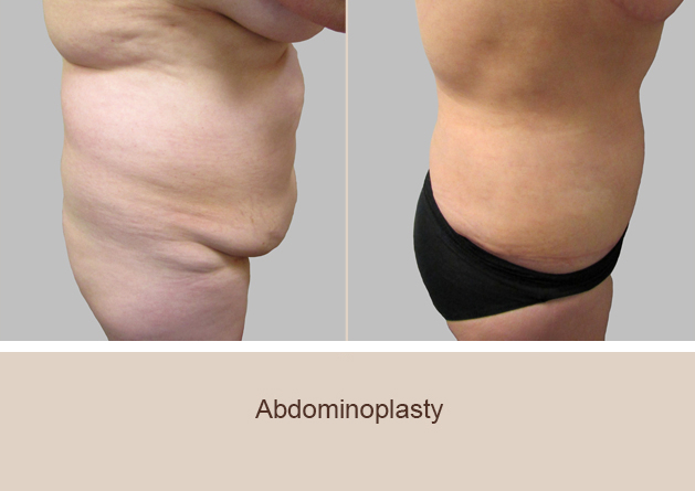 Before and After Image: Before and After Photos: Abdominoplasty (Tummy Tuck) - right-side