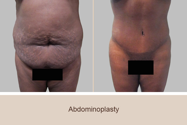 Before and After Image: Before and After Photos: Abdominoplasty (Tummy Tuck) - front