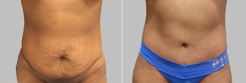 Before and After Image: Before and After Photos: Abdominoplasty (Tummy Tuck) - front