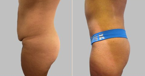 Before and After Image: Before and After Photos: Abdominoplasty (Tummy Tuck) - left-side