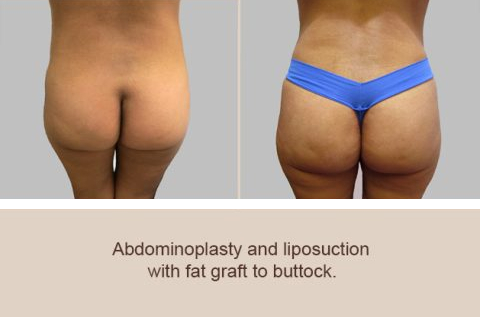 Before and After Image: Before and After Photos: Abdominoplasty (Tummy Tuck) - back