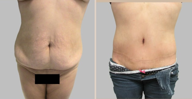 Before and After Image: Before and After Photos: Abdominoplasty (Tummy Tuck) - front