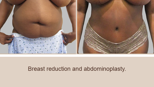 Before and After Image: Before and After Photos: Abdominoplasty (Tummy Tuck) - front