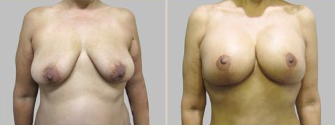 Before and After Image: Before and After Photos: Abdominoplasty (Tummy Tuck) - front