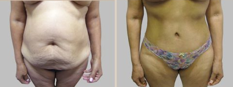 Before and After Image: Before and After Photos: Abdominoplasty (Tummy Tuck) - front
