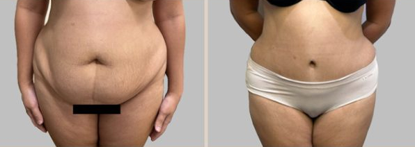 Before and After Image: Before and After Photos: Abdominoplasty (Tummy Tuck) - front