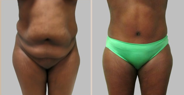 Before and After Image: Before and After Photos: Abdominoplasty (Tummy Tuck) - front