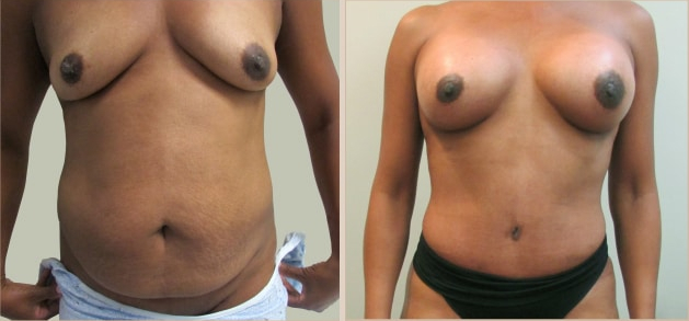 Before and After Image: Before and After Photos: Abdominoplasty (Tummy Tuck) - front