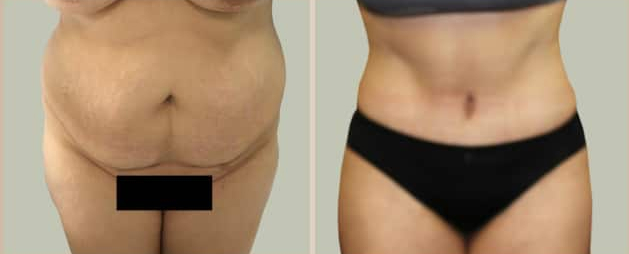 Before and After Image: Before and After Photos: Abdominoplasty (Tummy Tuck) - front