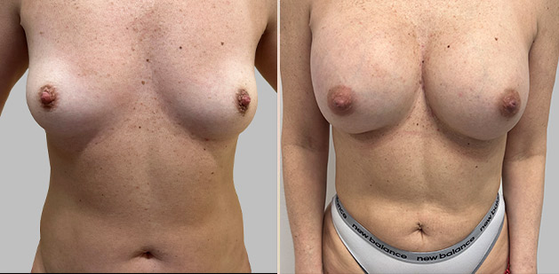 Before and After Image: Before and After Photos: Breast Augmentation and Lift - front
