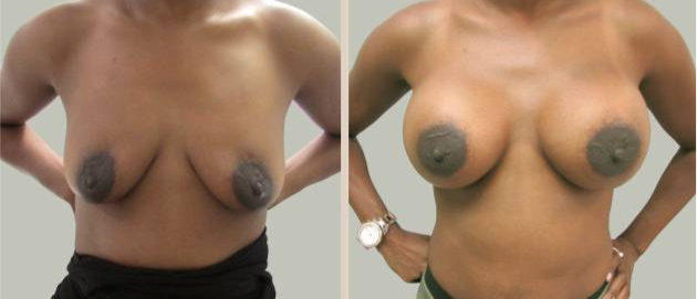 Before and After Image: Before and After Photos: Breast Augmentation (Breast Implants) - front