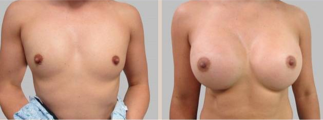 Before and After Image: Before and After Photos: Breast Augmentation (Breast Implants) - front