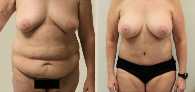 Before and After Image: Before and After Photos: Breast Augmentation (Breast Implants) - front
