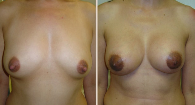 Before and After Image: Before and After Photos: Breast Augmentation (Breast Implants) - front