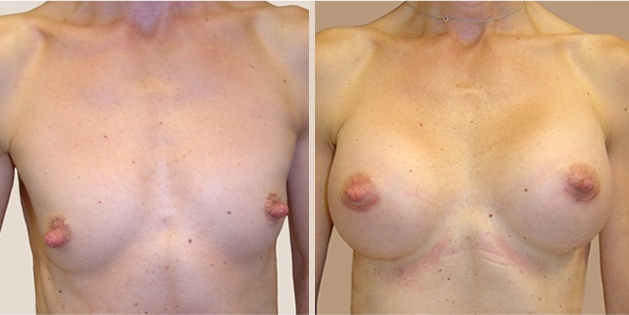 Before and After Image: Before and After Photos: Breast Augmentation (Breast Implants) - front