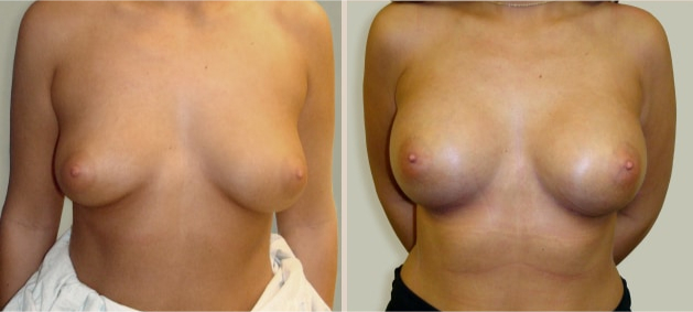 Before and After Image: Before and After Photos: Breast Augmentation (Breast Implants) - front