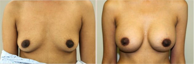 Before and After Image: Before and After Photos: Breast Augmentation (Breast Implants) - front