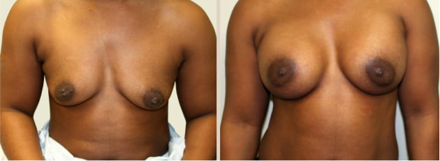 Before and After Image: Before and After Photos: Breast Augmentation (Breast Implants) - front