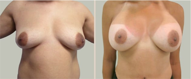 Before and After Image: Before and After Photos: Breast Augmentation (Breast Implants) - front