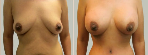Before and After Image: Before and After Photos: Breast Augmentation (Breast Implants) - front