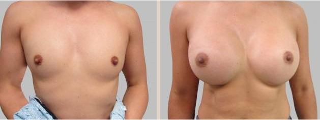 Before and After Image: Before and After Photos: Breast Augmentation (Breast Implants) - front