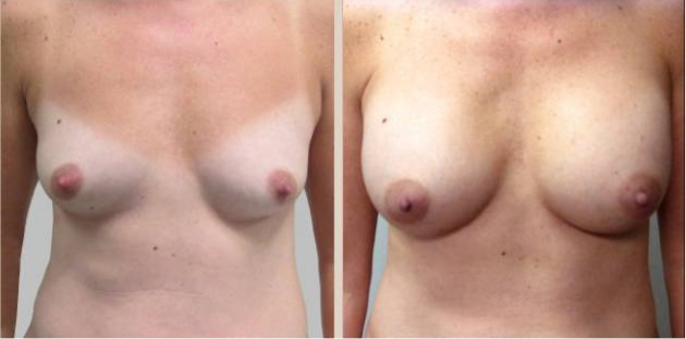 Before and After Image: Before and After Photos: Breast Augmentation (Breast Implants) - front
